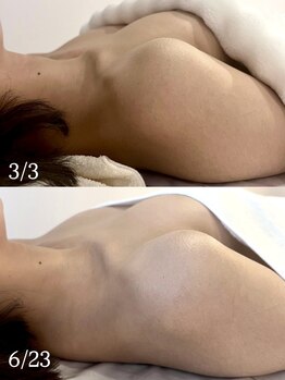 ブルーム(bluem)/約3ヶ月5回の施術でバストアップ