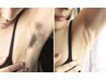 《女性ワキ脱毛》ハイパワーパワーライト美肌脱毛《脱毛¥3,000→¥2,000》40分