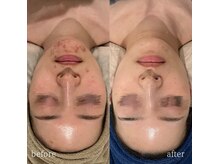 ニコリー(NICOLY)/赤ニキビケア症例【施術5回目】