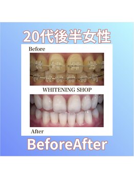 ホワイトニングショップ 西原店/20代後半女性☆BeforeAfter