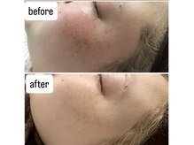 サロン ウーカ(salon WOOCA)/シミケアペン【シミ】