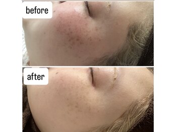 サロン ウーカ(salon WOOCA)/シミケアペン【シミ】