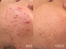 ウォーム(warm)/ニキビケア/肌荒れ/ニキビ肌