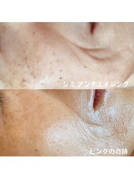 ピンクの奇跡/光フェイシャル