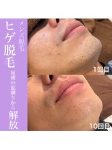 フリグス(Frigus)/【メンズ脱毛】