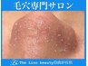 レディース/メンズ再来店【毛穴ごっそり毛穴レス60分￥15400】