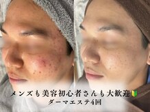ベネミー 恵比寿(Benemi)の雰囲気（メンズも美容初心者さんも大歓迎！ハーブピーリング/ララピール）