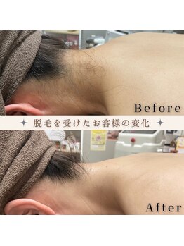 アミュレット(amulette)/うなじ脱毛も人気です！！