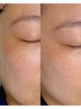 タイトプラス(tyto+)/プラチナプラピール