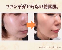 フェイスプラスリフ(FACE+RiF)
