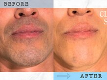 ラッシュ(RUSH)/8回で青ヒゲ卒業！