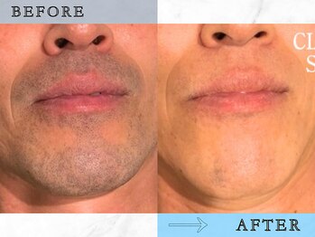 ラッシュ(RUSH)/8回で青ヒゲ卒業!