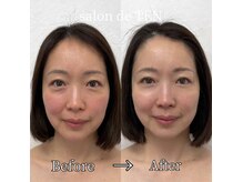 サロンド テン 広尾(salon de TEN)の雰囲気(ハーブピーリング、ララピール、WiQoピーリングをセレクト)