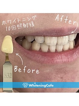 ホワイトニングカフェ 池袋東口店/ホワイトニングビフォーアフター