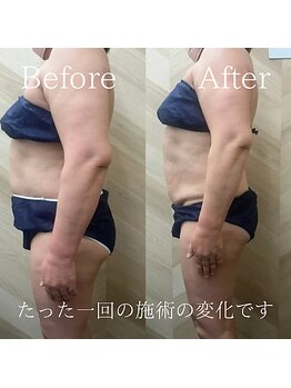介正鍼灸整骨院 整体院 エフコープ大野城店/痩身エステ／ビフォーアフター