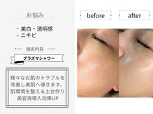 シロ(CHILO)/プラズマシャワーbefore・after