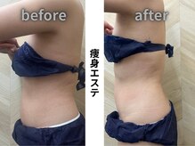 介正鍼灸整骨院 整体院 エフコープ大野城店の雰囲気（痩身エステ週１回×3回のビフォーアフターです*。）