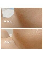 ココプレジール(Cocoplaisir)/バクテリウムピール/毛穴