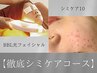 【徹底シミケアコース】シミケア10+BBL光フェイシャル（600ショット）セット
