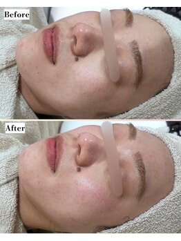 ソワナ(soina)/【神楽坂駅/フェイシャル/毛穴】