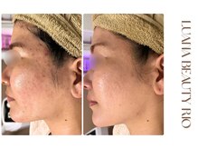 リオ(RIO)/月一ケアでもここまでの変化★