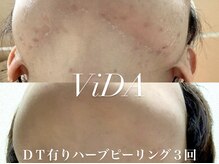ヴィーダ 渋谷松濤(ViDA)/REVI DT有りハーブピーリング