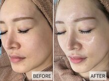 エナ(ENA)の雰囲気(<ピーリング>BEFORE→AFTER ハリ・ツヤ・透明感のある肌へ)