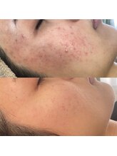 プレジール(Plaisir)/バクテリウムピール