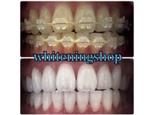 ホワイトニングショップ 津店の雰囲気（ホワイトニングは矯正をしている方も受けていただけます◎）