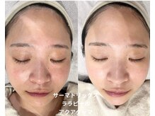 レアビューティー(Le'a beauty)/最強肌管理メニュー