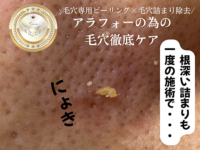 毛穴エステ 込900円 楽天市場】毛穴 黒ずみ 除去 吸引器 光エステ 毛穴ケア美顔器