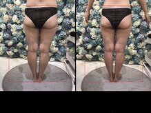 ルル(Lulu's)/脂肪ほぐし1回施術結果