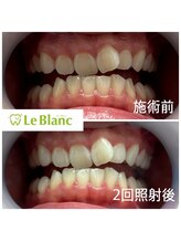 ルブラン 奈良店(Le Blanc)/3週間で綺麗な歯に！