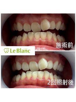 ルブラン 奈良店(Le Blanc)/3週間で綺麗な歯に！