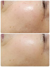 プレイス 天王寺店(PLACE)/ハーブピーリング