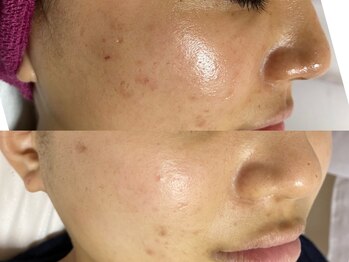 アイラッシュ ラピス(Lapis)/ニキビにお悩みの方に