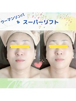 メディカルサロン かとれあ/スーパーリフト