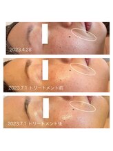 ヨリ(yori)/ハーブトリートメント3回