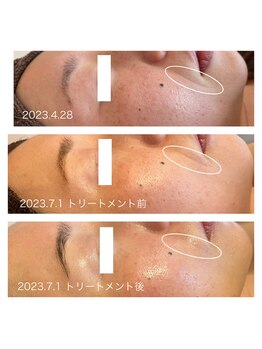 ヨリ(yori)/ハーブトリートメント3回