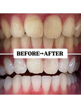 ホワイトニングサロン 豊中/Before&After美白ホワイトニング