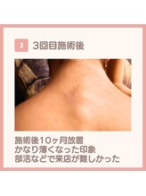 ブルハ(Bruja)/【脱毛 Before→After】 3