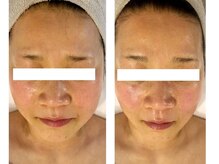 リセル(RE.cell)/糸リフト10本