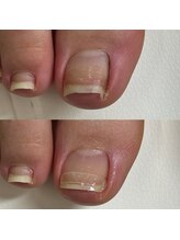 リリ(lili)/巻き爪矯正/3回目