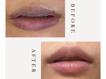 イオ(‘IO)/リップのメラニンケア