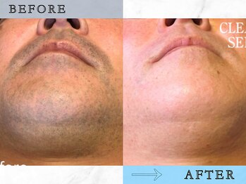 ラッシュ(RUSH)/カミソリ負け→ツルツルに!