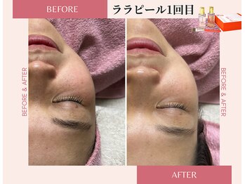 ラシック(La chic)/毛穴洗浄/ララピール大阪心斎橋