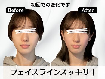 ハリユナイテッド 原宿鍼灸 整体院(HALI UNITED)/フェイスラインもスッキリ!