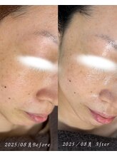 サロン ド エン(Salon de. en)/肌荒れケア◇ハーブピーリング