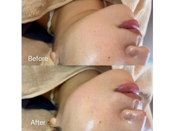 イーズ(eees)/フェイシャルwaxでモミアゲケア