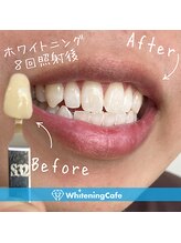 ホワイトニングカフェ 池袋東口店/ホワイトニングビフォーアフター